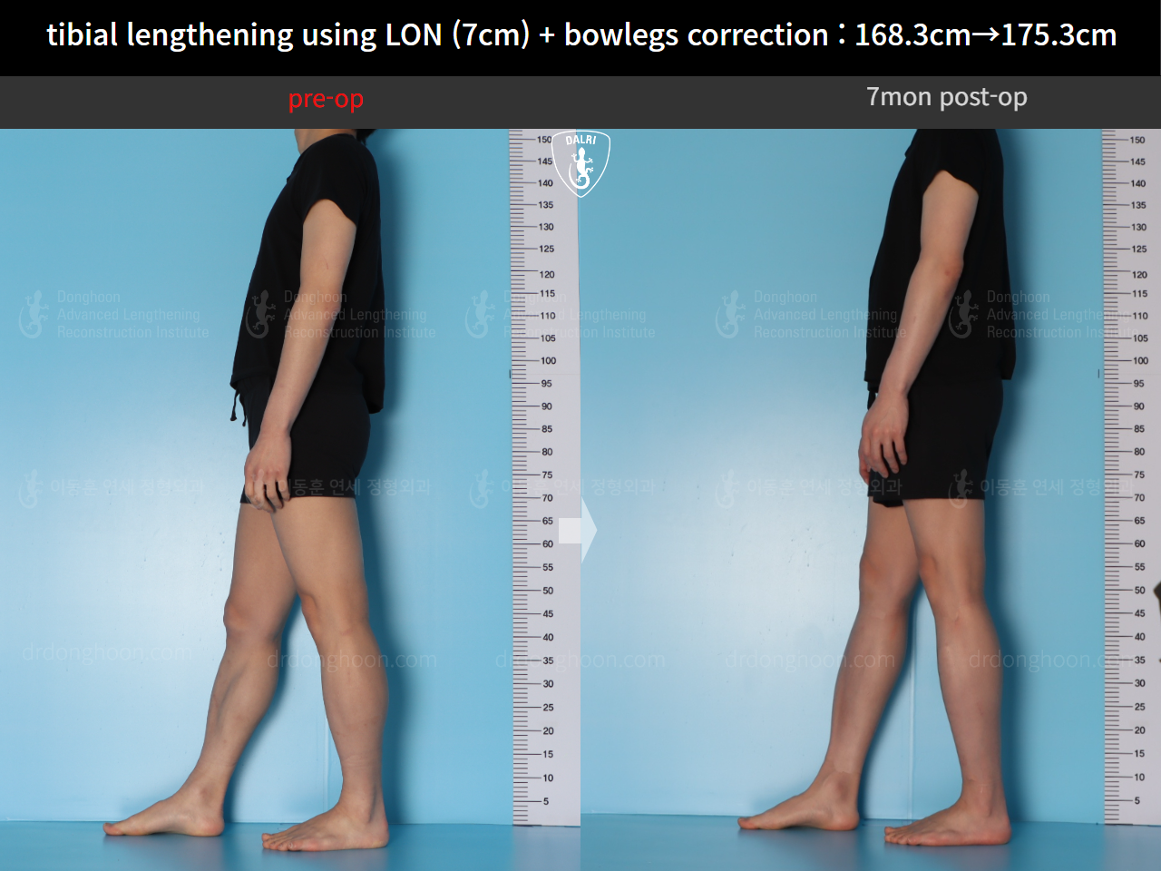 Before and after cll + deformity correction, case 21918246, image 4, Dr. Donghoon institute (DALRI)
