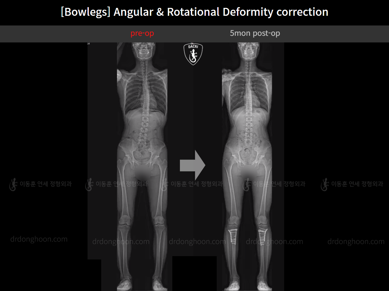Before and after adult bowlegs, case 14707617, image 9, Dr. Donghoon institute (DALRI)