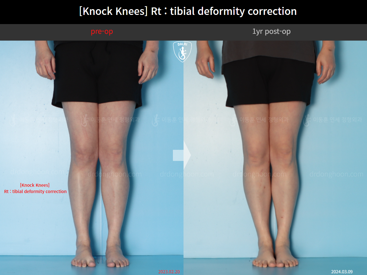 Before and after adult knock knees, case 18411627, image 5, Dr. Donghoon institute (DALRI)