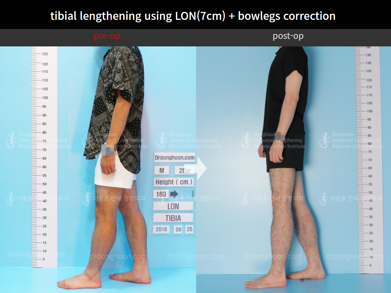 Before and after cll + deformity correction, case 4585644, image 3, Dr. Donghoon institute (DALRI)