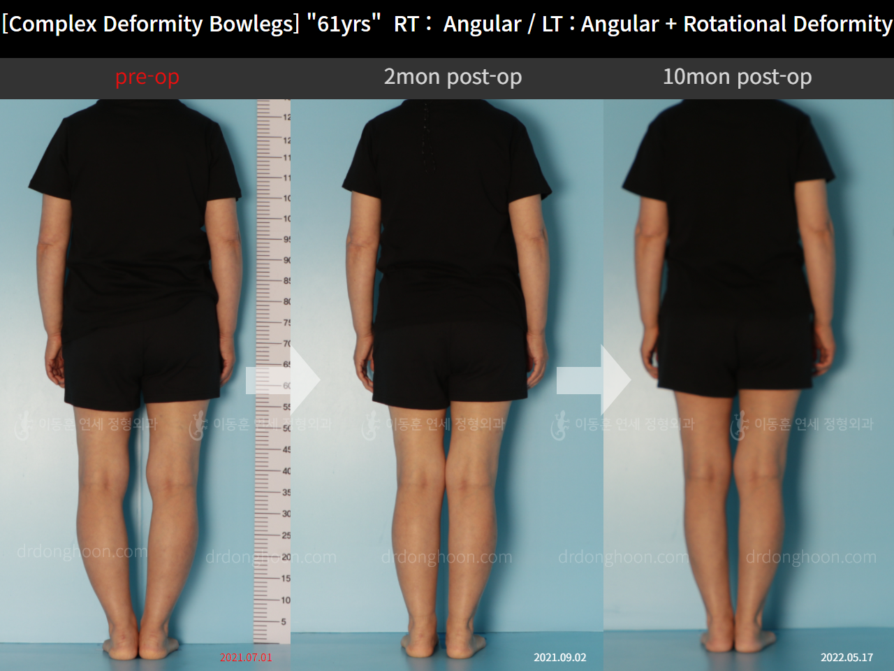 Before and after osteotomy for knee osteoarthritis, case 11576611, image 2, Dr. Donghoon institute (DALRI)