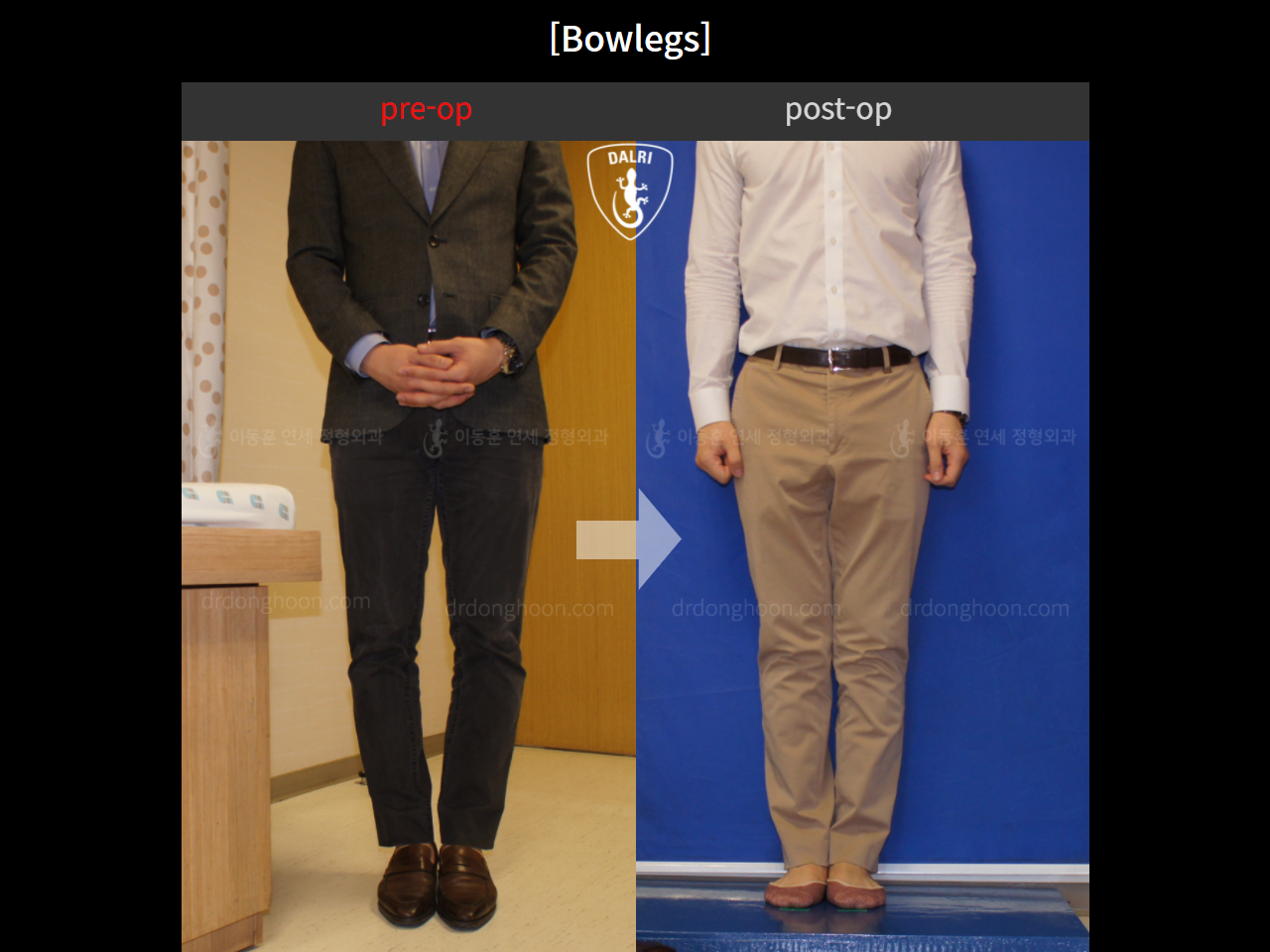Before and after adult bowlegs, case 4311021, image 5, Dr. Donghoon institute (DALRI)
