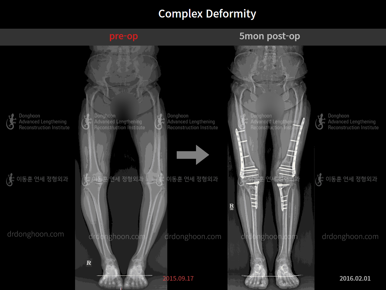 Before and after osteotomy for knee osteoarthritis, case 11313549, image 1, Dr. Donghoon institute (DALRI)