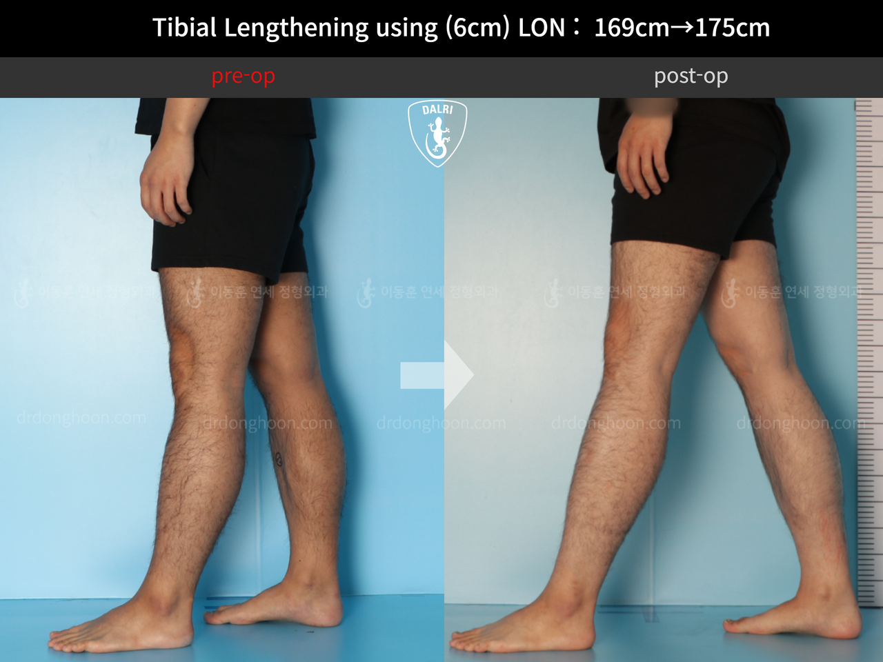 Before and after cll lon, case 12279515, image 8, Dr. Donghoon institute (DALRI)