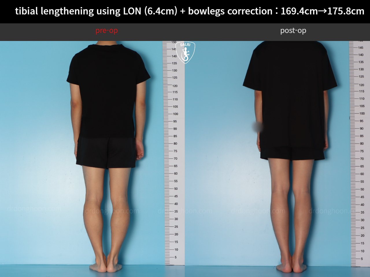 Before and after cll + deformity correction, case 36736776, image 2, Dr. Donghoon institute (DALRI)