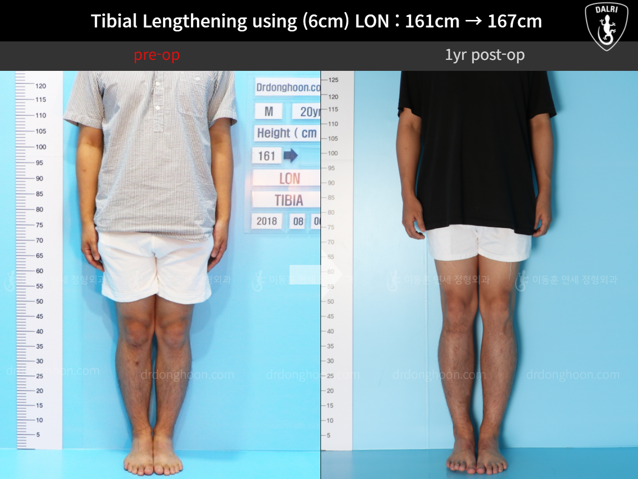 Before and after cll lon, case 11654440, image 3, Dr. Donghoon institute (DALRI)