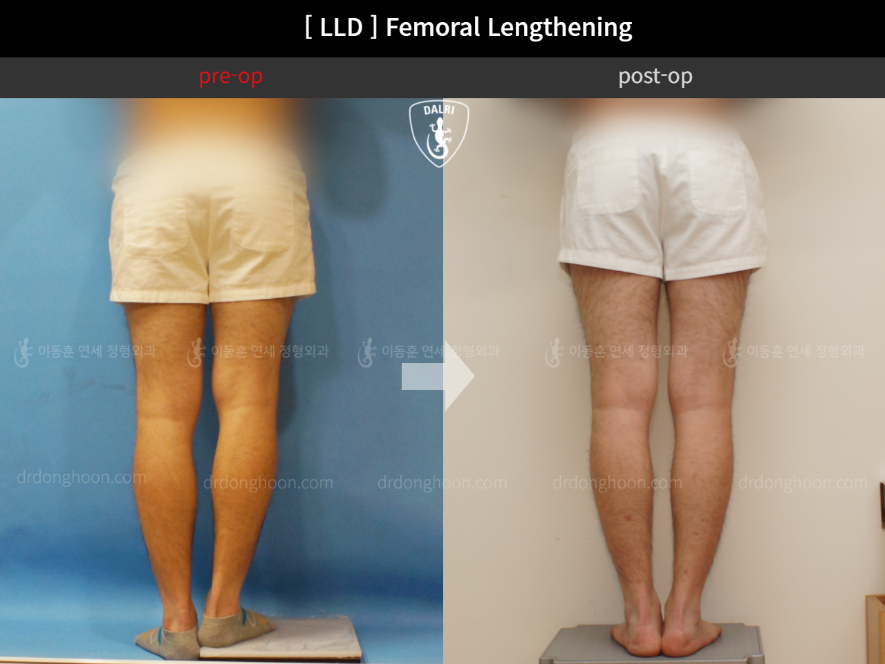 Before and after adult lld, case 11651275, image 4, Dr. Donghoon institute (DALRI)