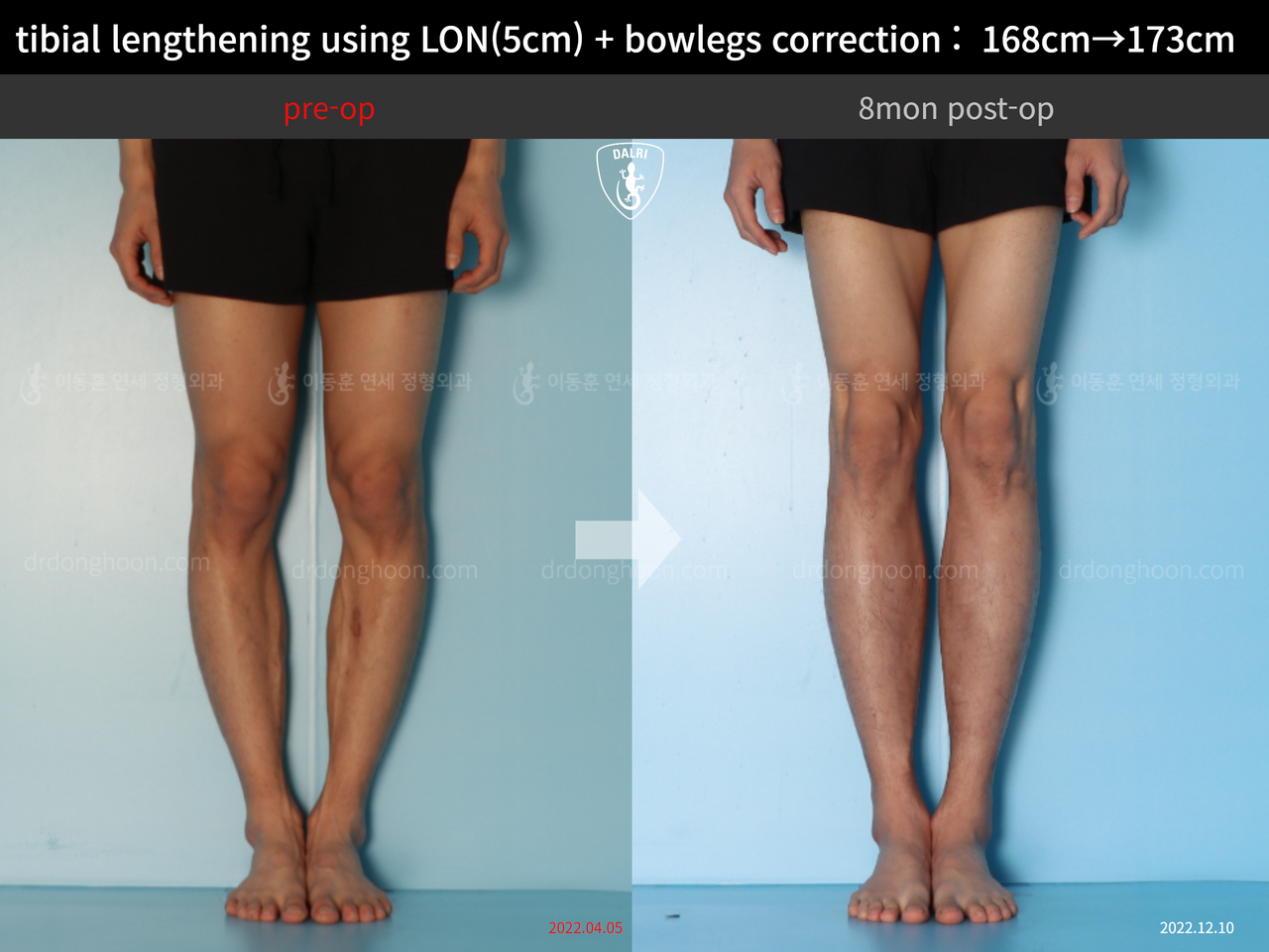 Before and after cll lon, case 13661175, image 7, Dr. Donghoon institute (DALRI)