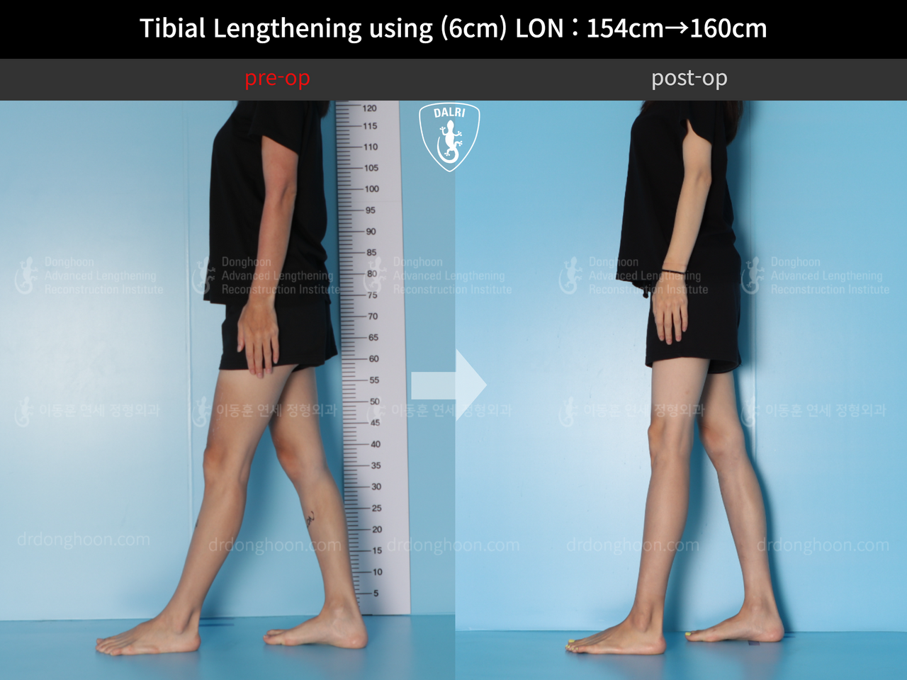 Before and after cll lon, case 12786266, image 4, Dr. Donghoon institute (DALRI)