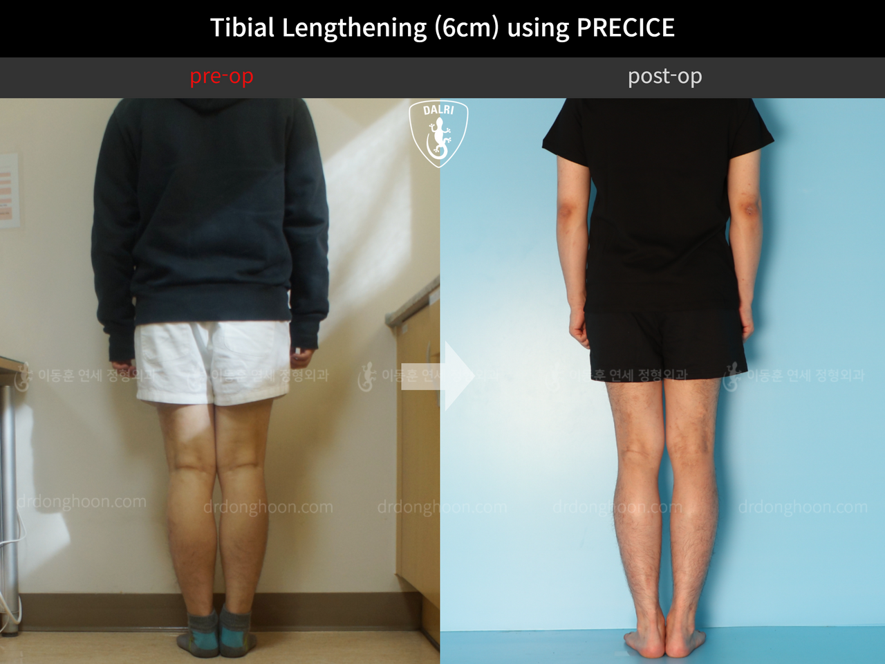 Before and after cll precice, case 11882006, image 2, Dr. Donghoon institute (DALRI)