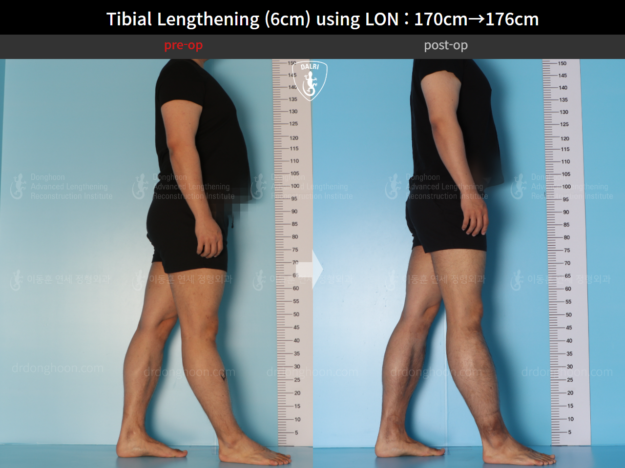 Before and after cll lon, case 15623962, image 4, Dr. Donghoon institute (DALRI)