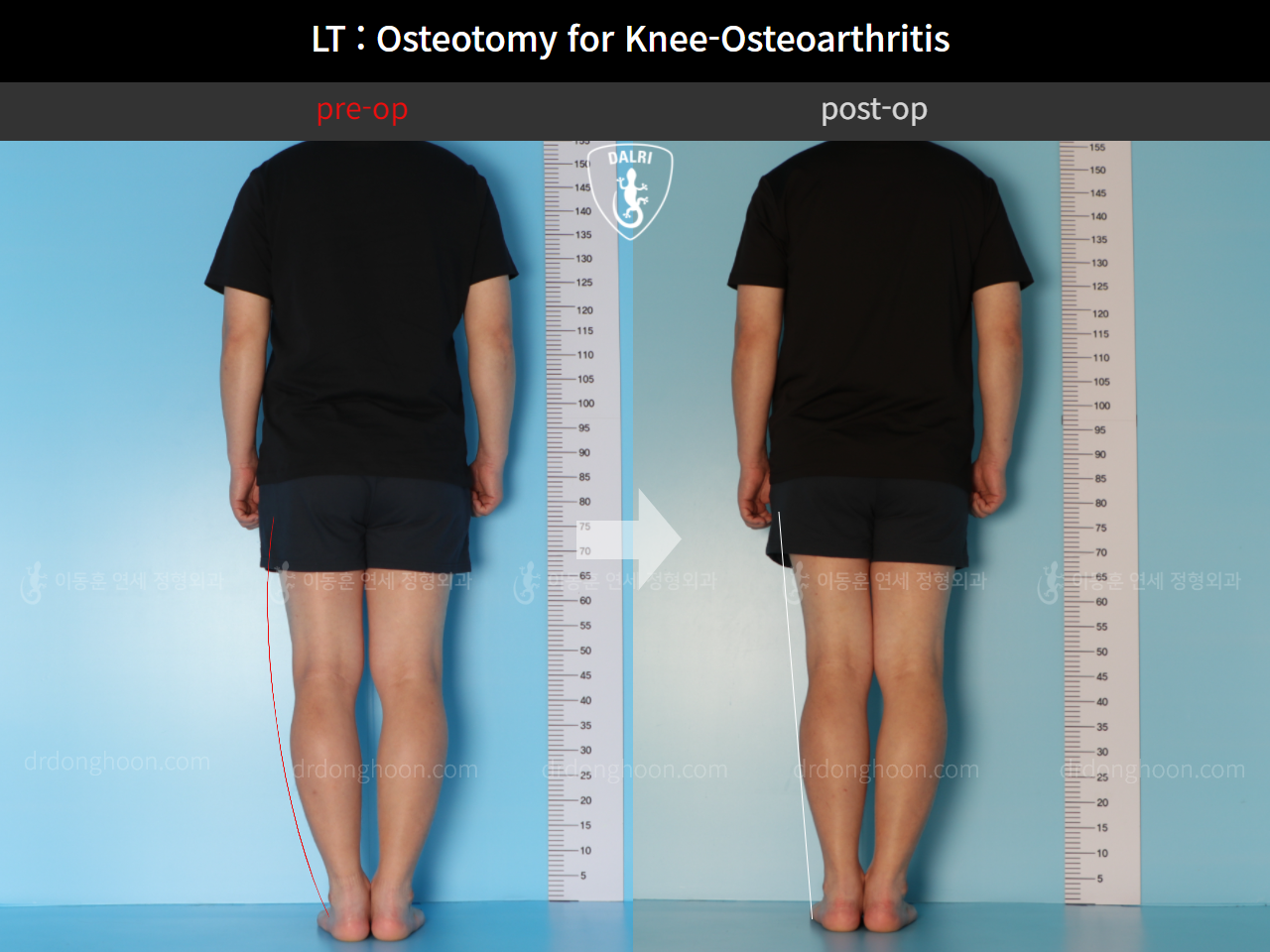 Before and after osteotomy for knee osteoarthritis, case 11065448, image 3, Dr. Donghoon institute (DALRI)