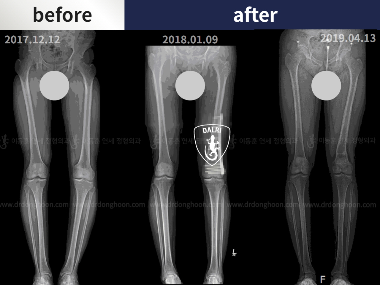 Before and after paediatric & adolescent bowlegs, case 4320255, image 3, Dr. Donghoon institute (DALRI)