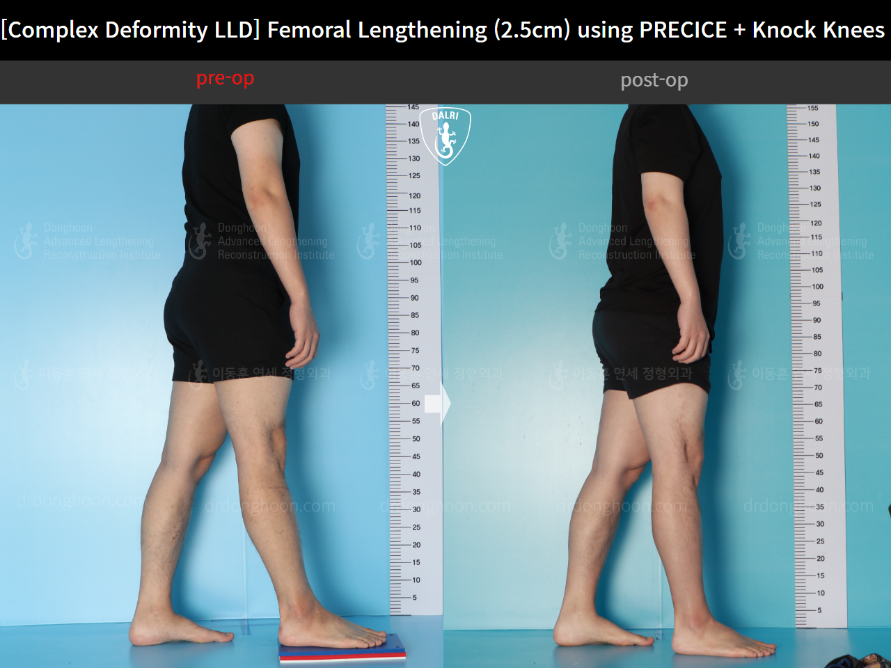 Before and after adult lld, case 17589131, image 4, Dr. Donghoon institute (DALRI)