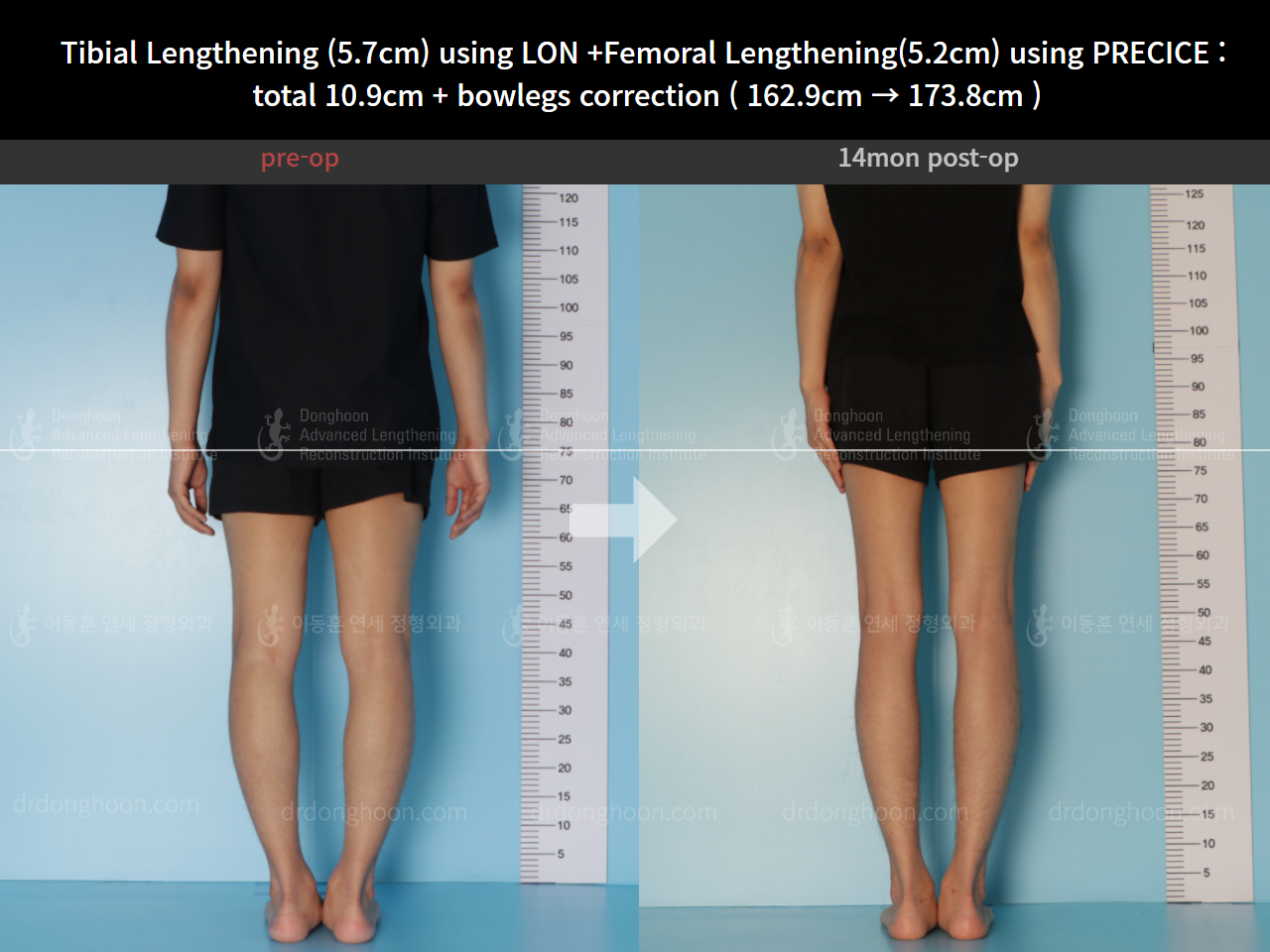 Before and after cll + deformity correction, case 8417894, image 2, Dr. Donghoon institute (DALRI)