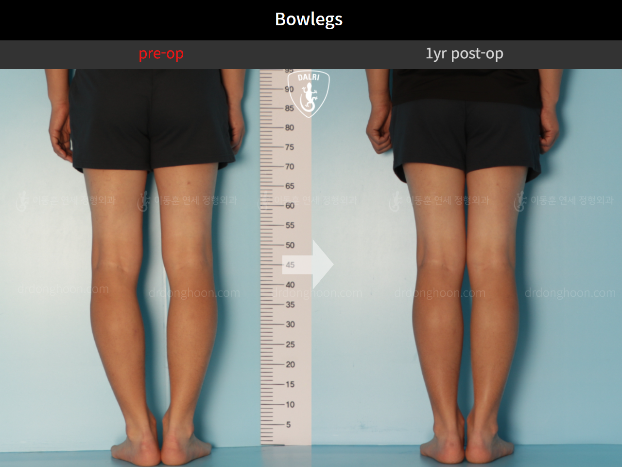 Before and after adult bowlegs, case 9487634, image 4, Dr. Donghoon institute (DALRI)