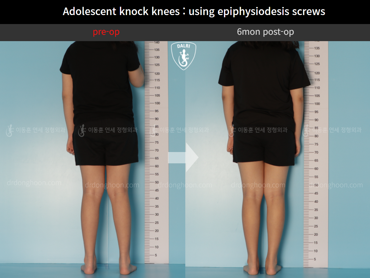 Before and after paediatric & adolescent knock knees, case 9626556, image 2, Dr. Donghoon institute (DALRI)