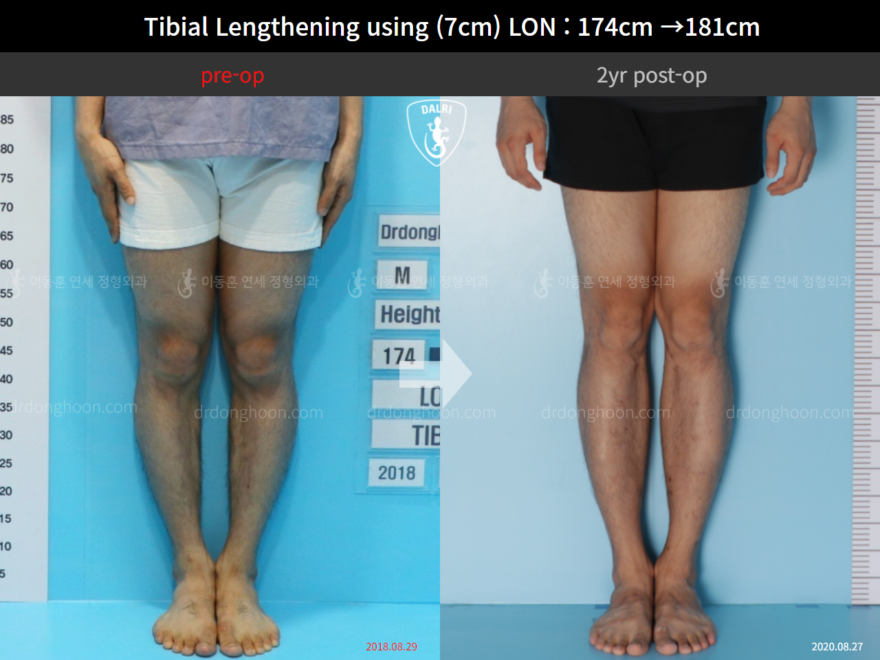Before and after cll lon, case 5316185, image 5, Dr. Donghoon institute (DALRI)