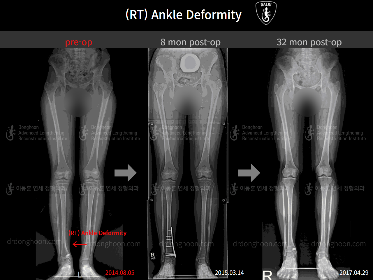 Before and after foot & ankle deformity, case 4248008, image 6, Dr. Donghoon institute (DALRI)