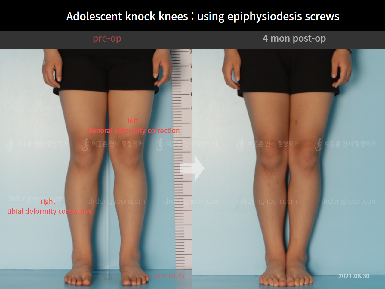 Before and after paediatric & adolescent knock knees, case 7977107, image 3, Dr. Donghoon institute (DALRI)