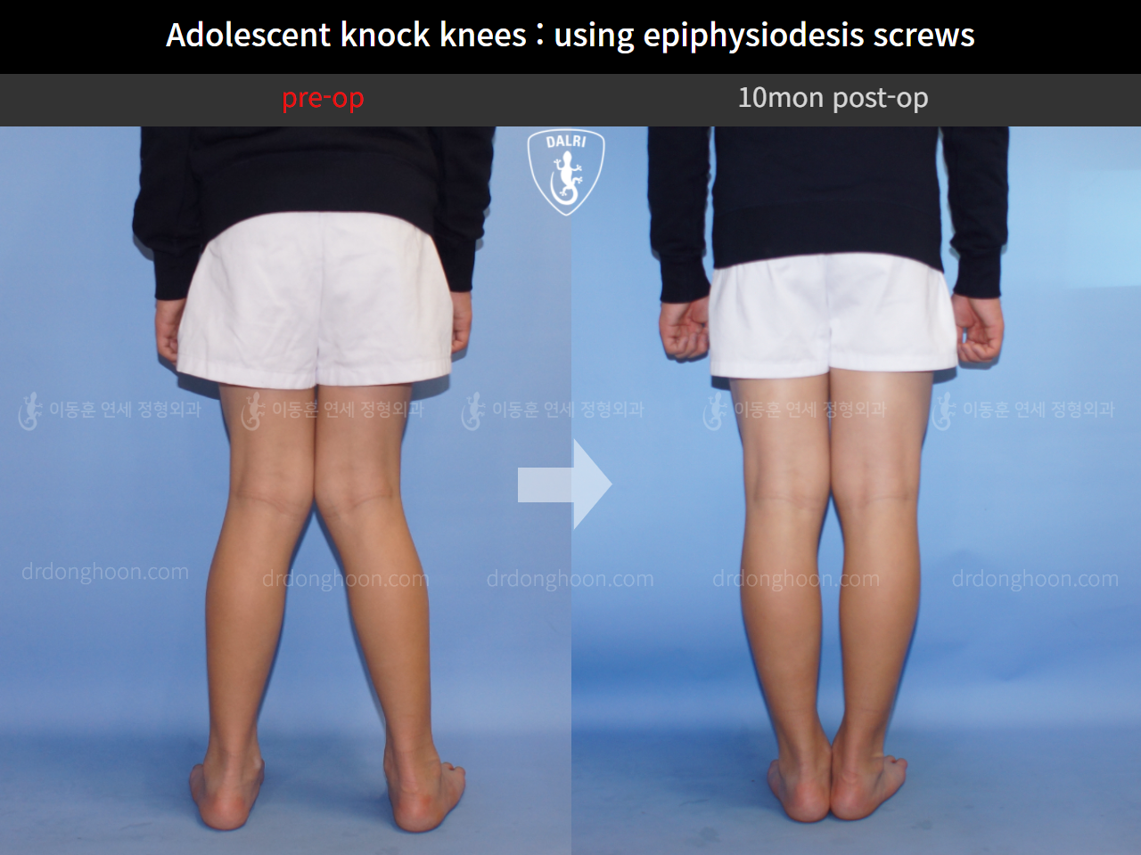 Before and after paediatric & adolescent knock knees, case 4310936, image 4, Dr. Donghoon institute (DALRI)