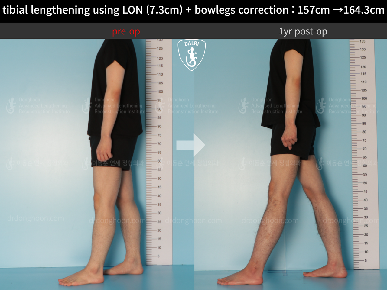 Before and after cll + deformity correction, case 13152543, image 4, Dr. Donghoon institute (DALRI)