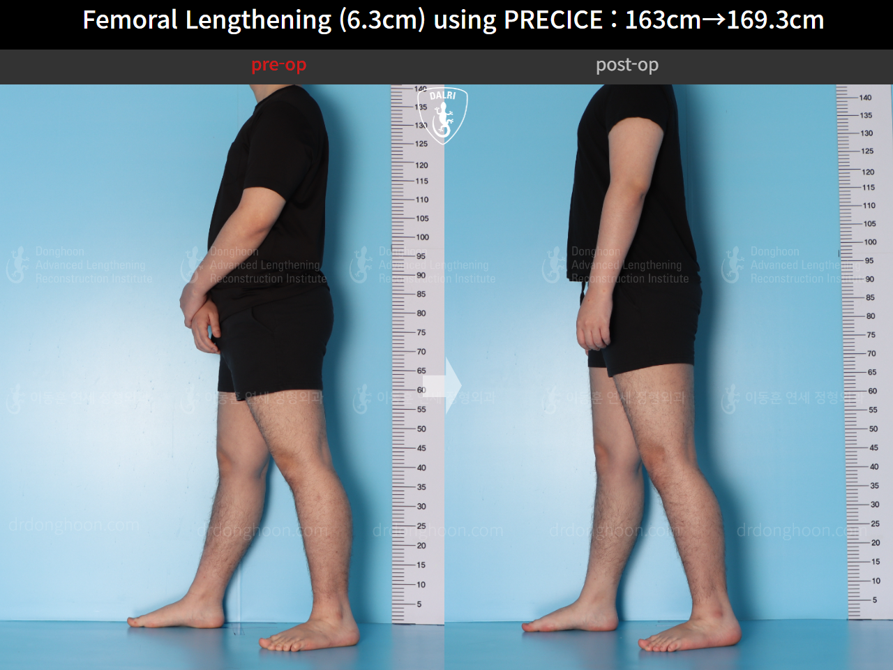 Before and after cll precice, case 15639837, image 6, Dr. Donghoon institute (DALRI)