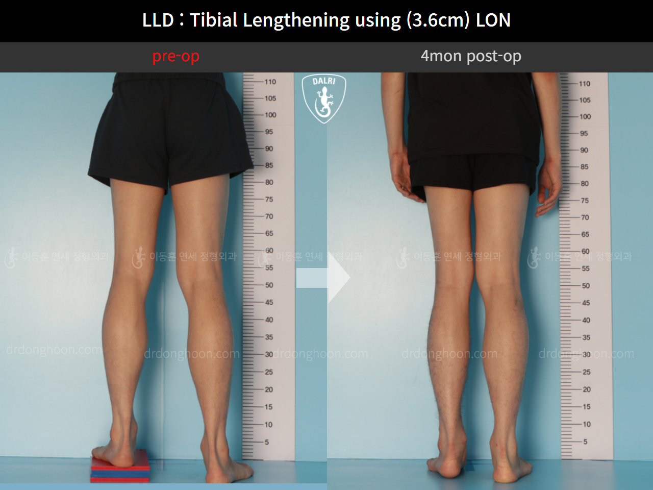 Before and after adult lld, case 11093753, image 5, Dr. Donghoon institute (DALRI)