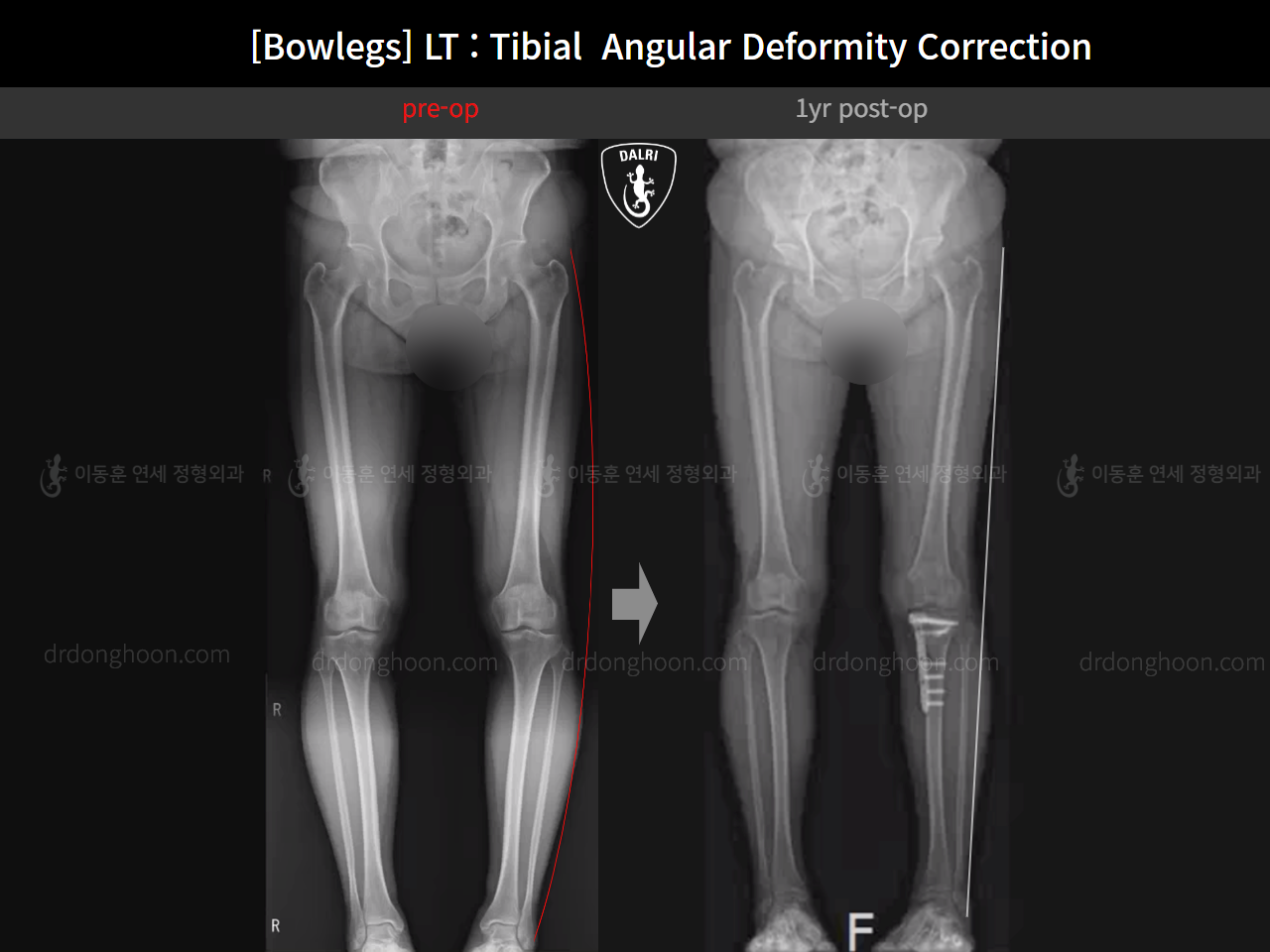 Before and after adult bowlegs, case 16787003, image 9, Dr. Donghoon institute (DALRI)