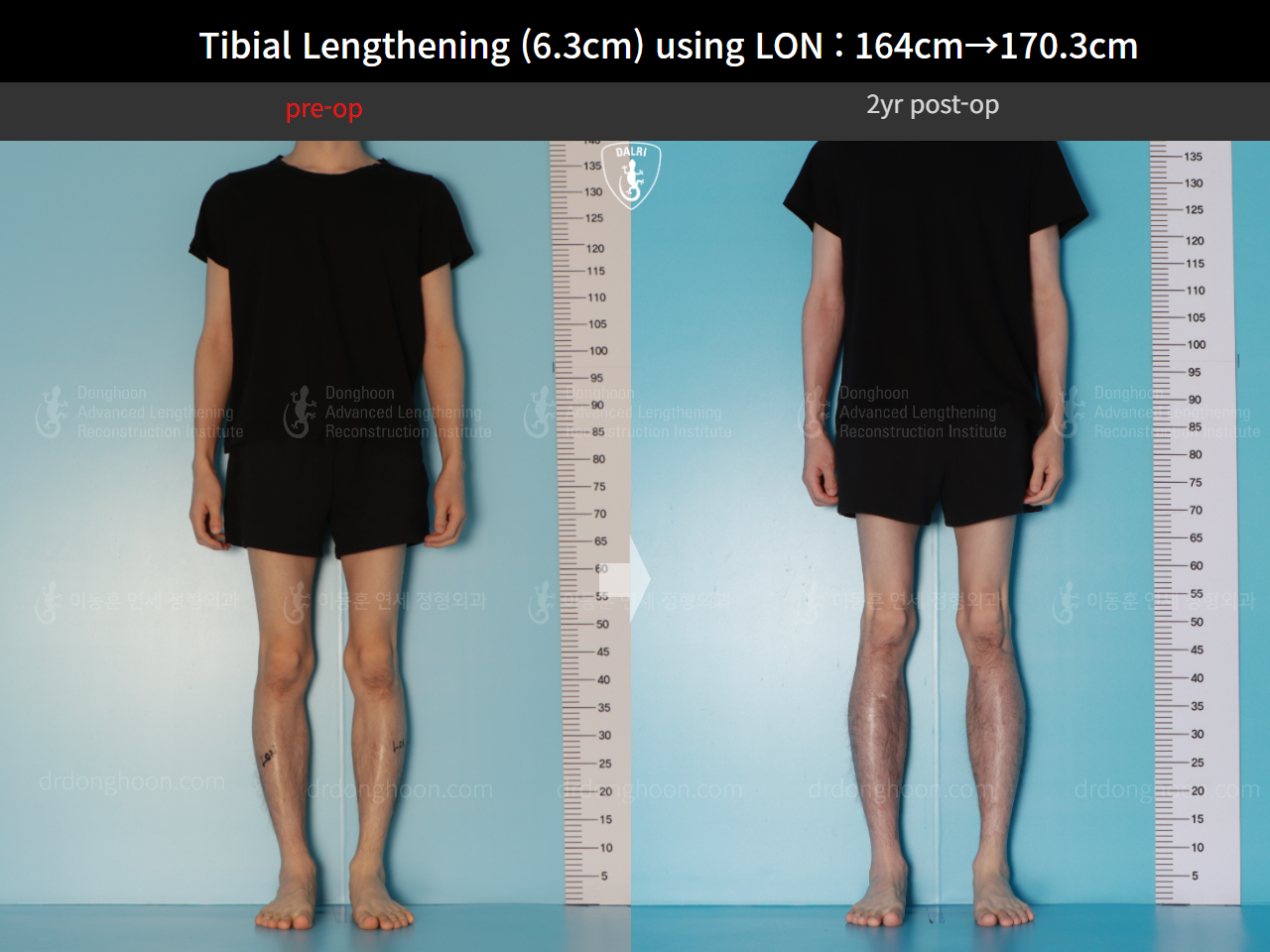 Before and after cll lon, case 16723608, image 2, Dr. Donghoon institute (DALRI)