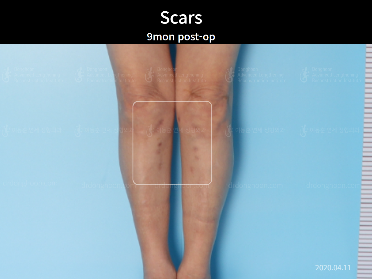 Before and after osteotomy for knee osteoarthritis, case 4306392, image 5, Dr. Donghoon institute (DALRI)