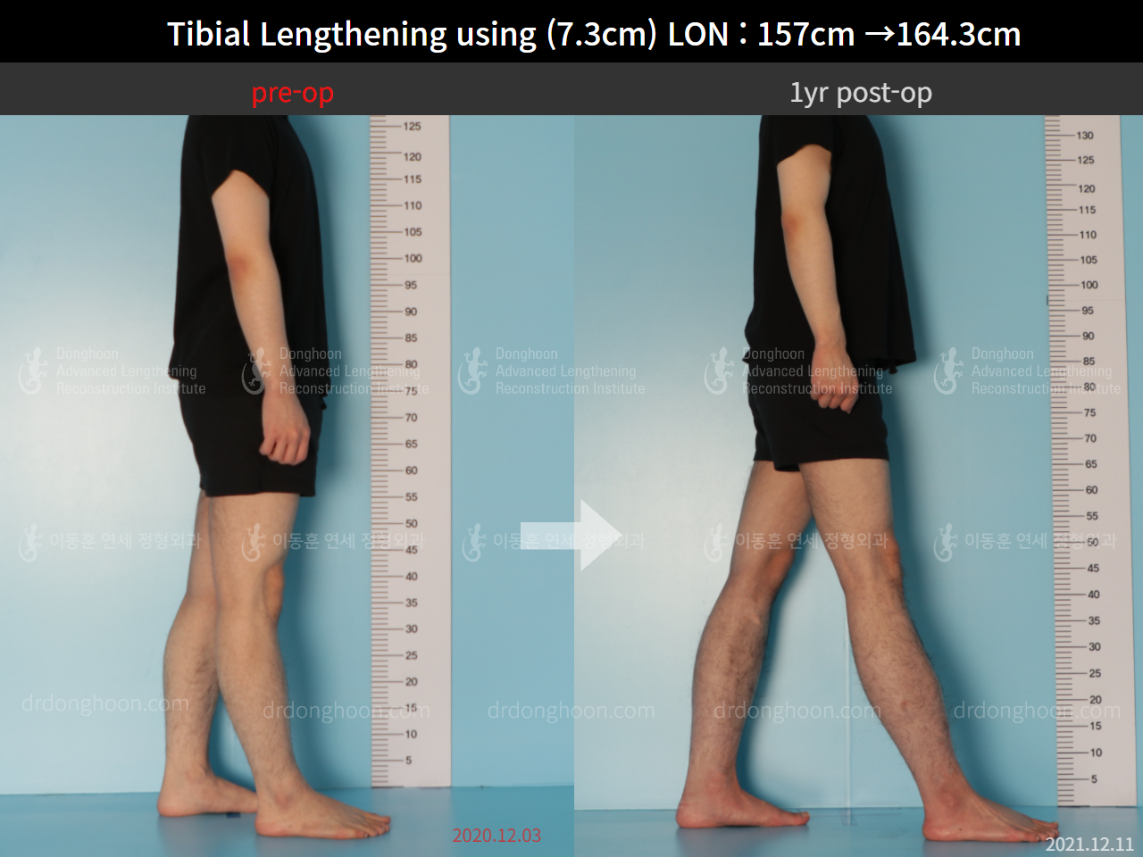 Before and after cll lon, case 9114235, image 3, Dr. Donghoon institute (DALRI)