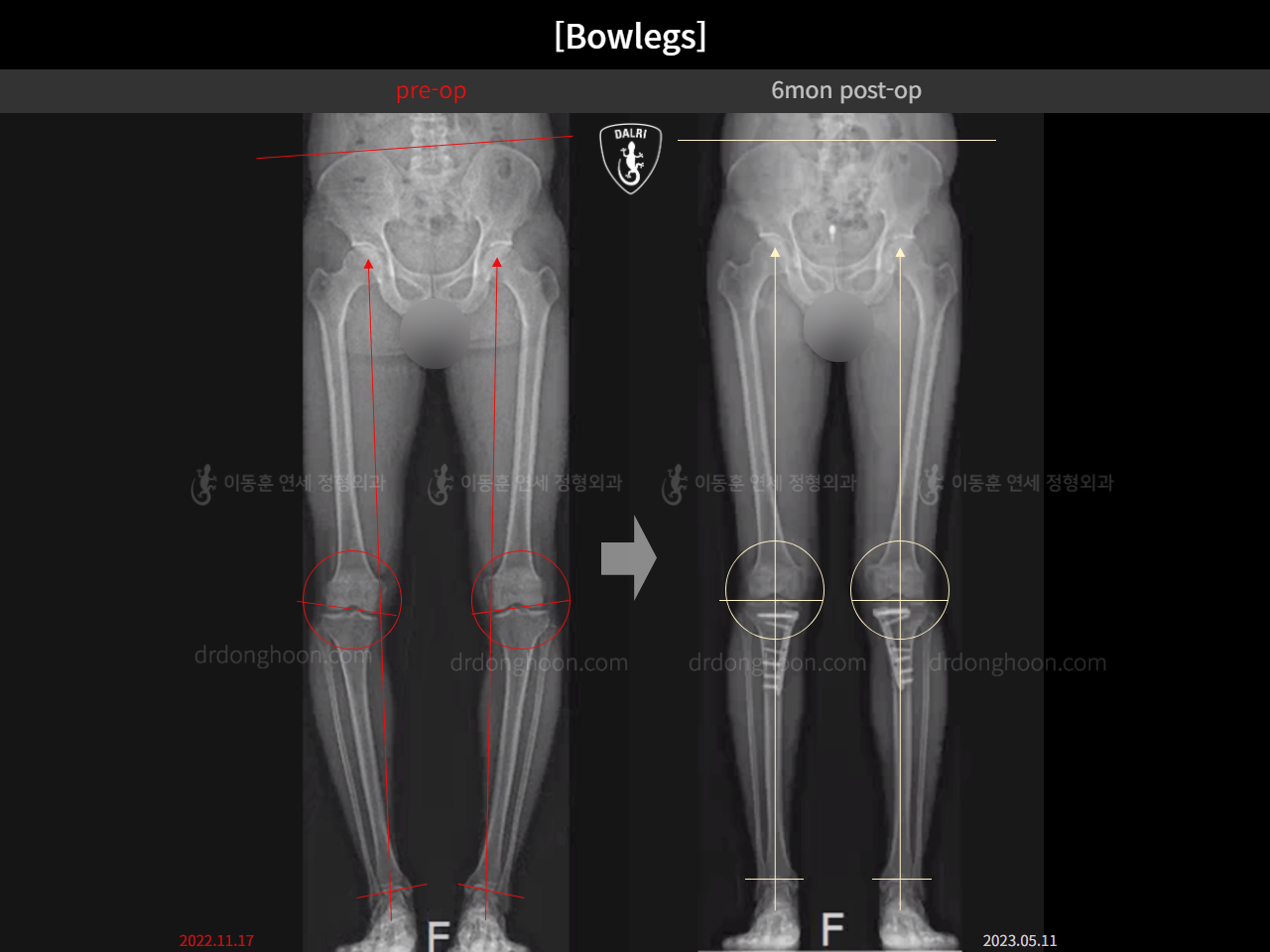 Before and after adult bowlegs, case 15161898, image 3, Dr. Donghoon institute (DALRI)