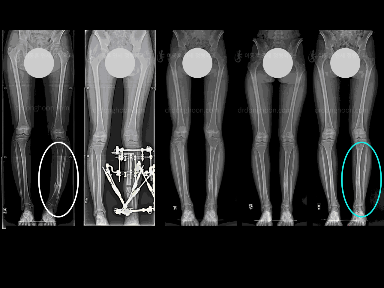 Before and after foot & ankle deformity, case 4354996, image 5, Dr. Donghoon institute (DALRI)
