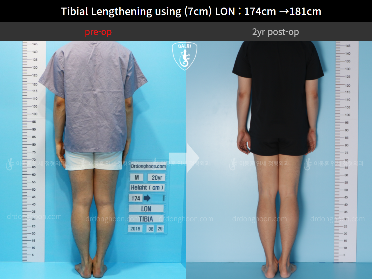 Before and after cll lon, case 5316185, image 2, Dr. Donghoon institute (DALRI)