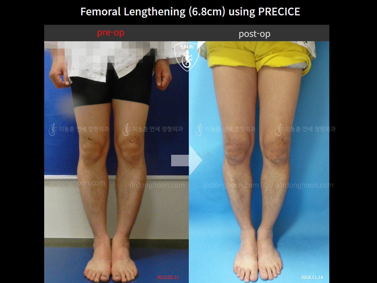 Before and after cll precice, case 4323358, image 1, Dr. Donghoon institute (DALRI)