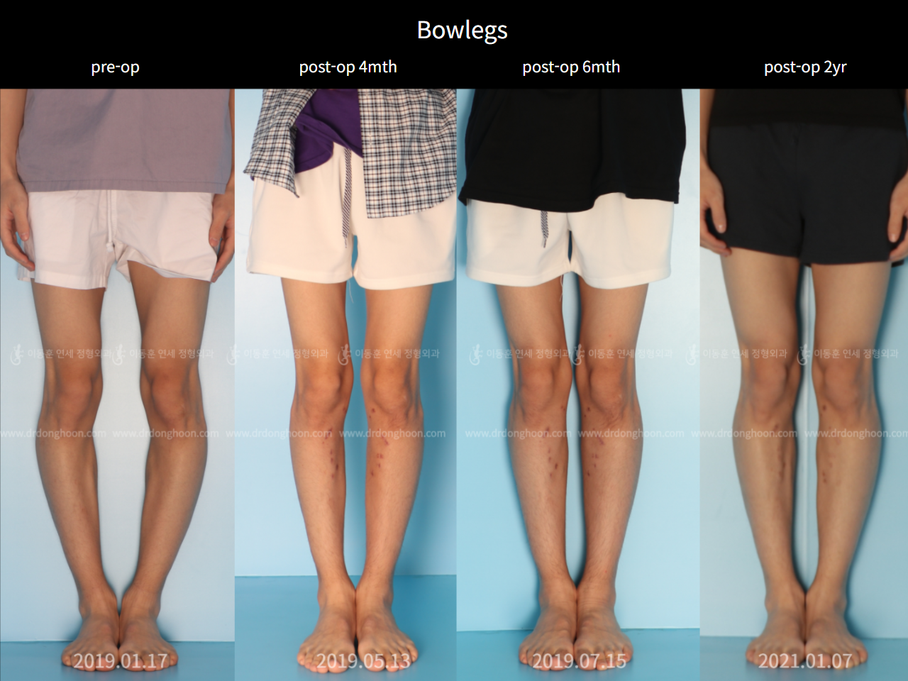 Before and after adult bowlegs, case 6779439, image 1, Dr. Donghoon institute (DALRI)
