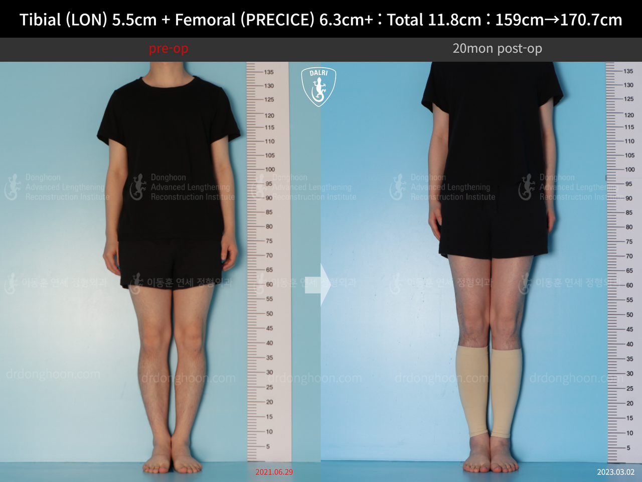 Before and after cll lon, case 14390077, image 3, Dr. Donghoon institute (DALRI)