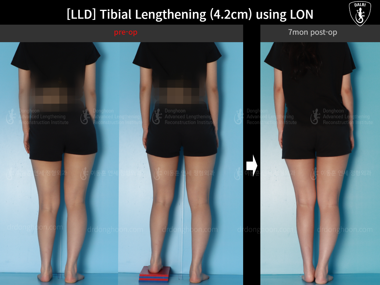 Before and after adult lld, case 16933852, image 2, Dr. Donghoon institute (DALRI)
