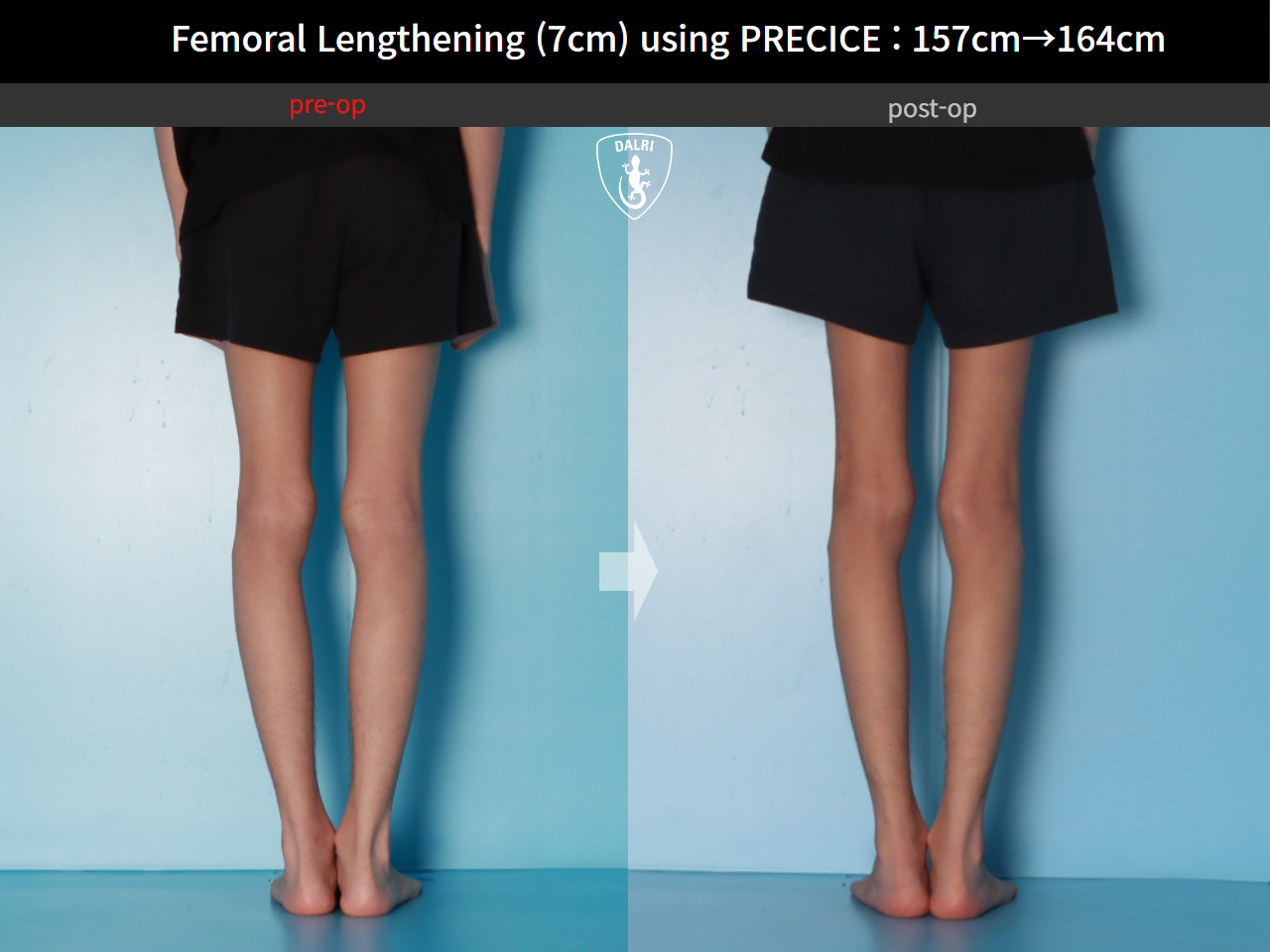 Before and after cll precice, case 31554406, image 8, Dr. Donghoon institute (DALRI)