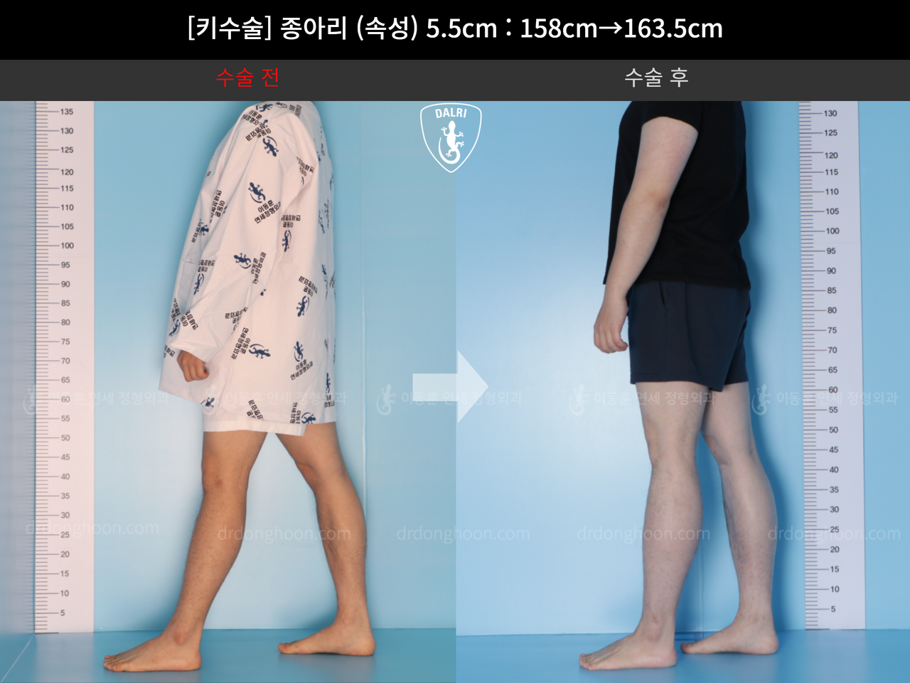 Before and after cll lon, case 4577764, image 4, Dr. Donghoon institute (DALRI)