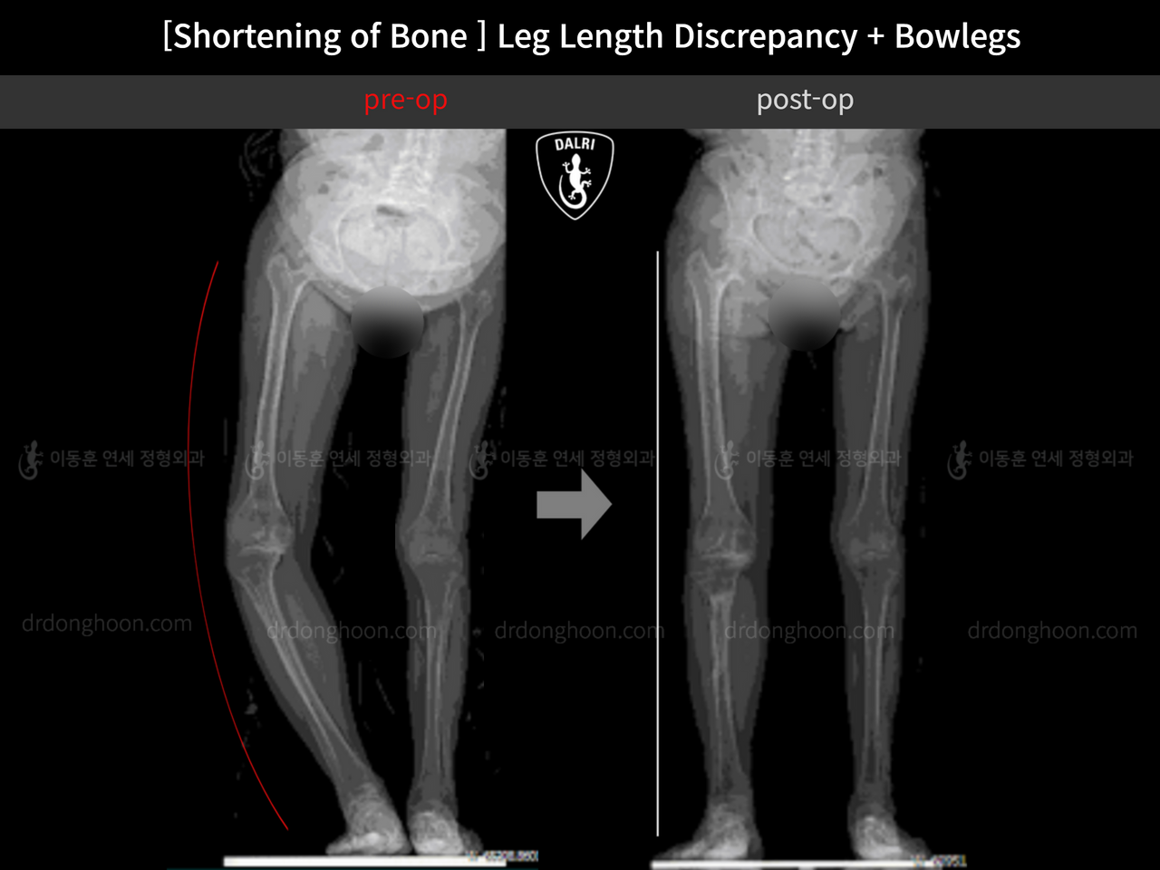 Before and after shortening of limb, case 12291476, image 2, Dr. Donghoon institute (DALRI)