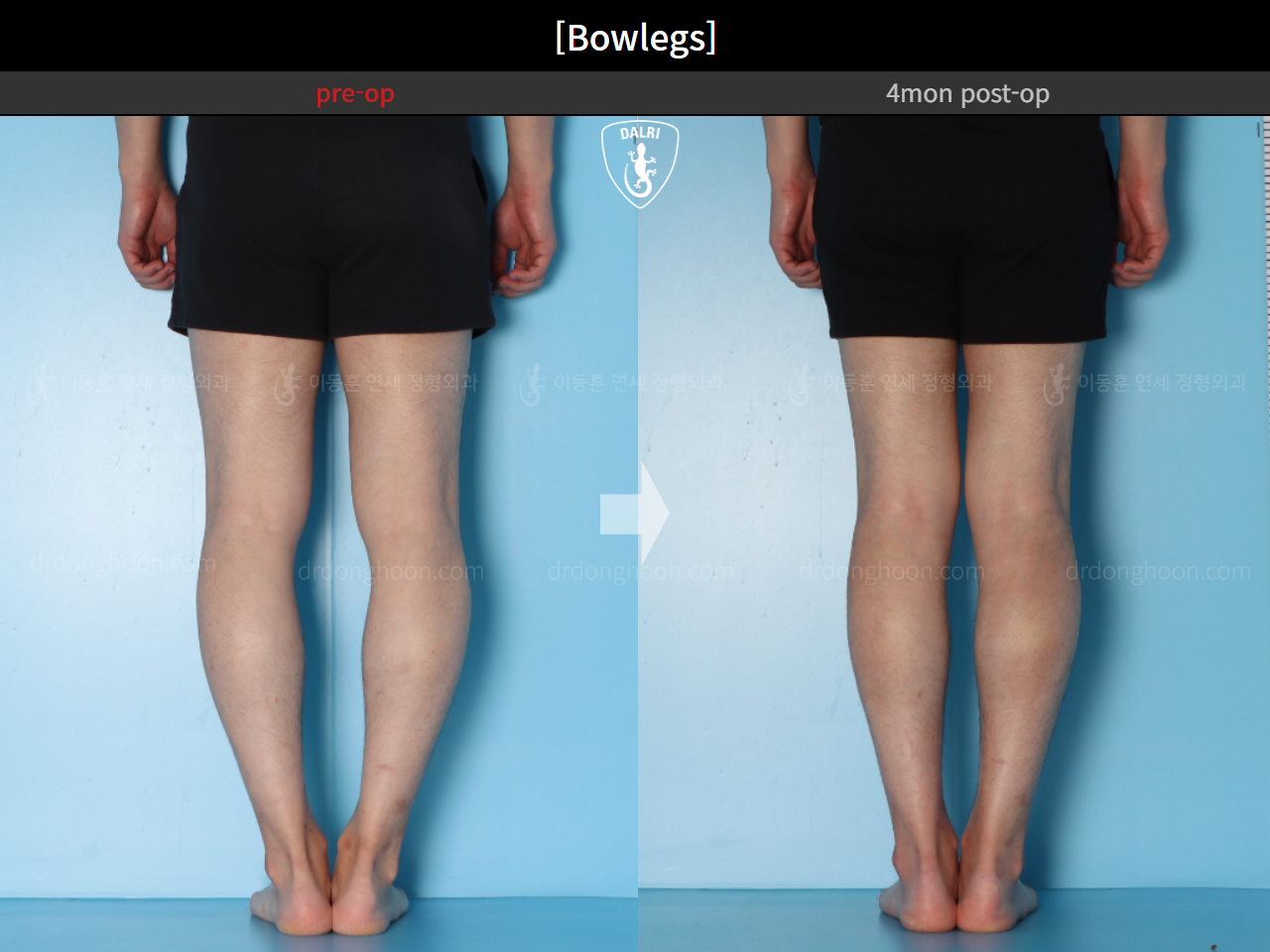 Before and after adult bowlegs, case 15650289, image 7, Dr. Donghoon institute (DALRI)