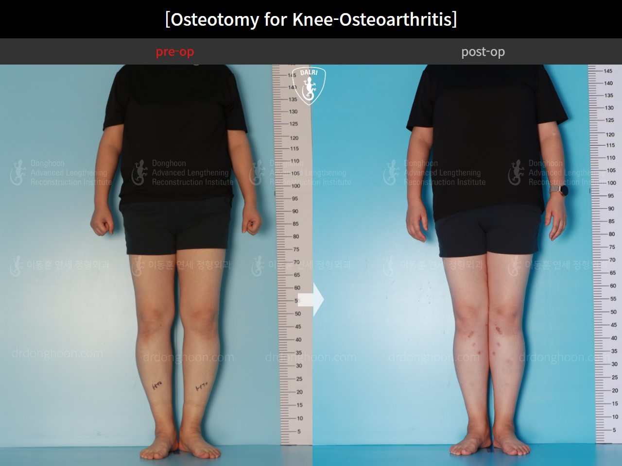 Before and after osteotomy for knee osteoarthritis, case 15944917, image 3, Dr. Donghoon institute (DALRI)