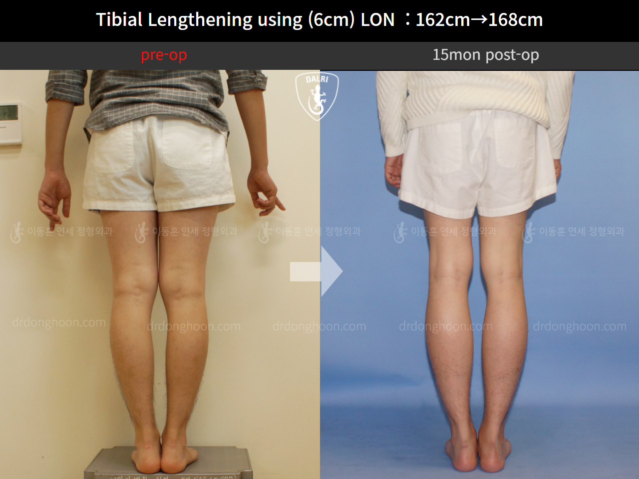 Before and after cll lon, case 4323473, image 2, Dr. Donghoon institute (DALRI)