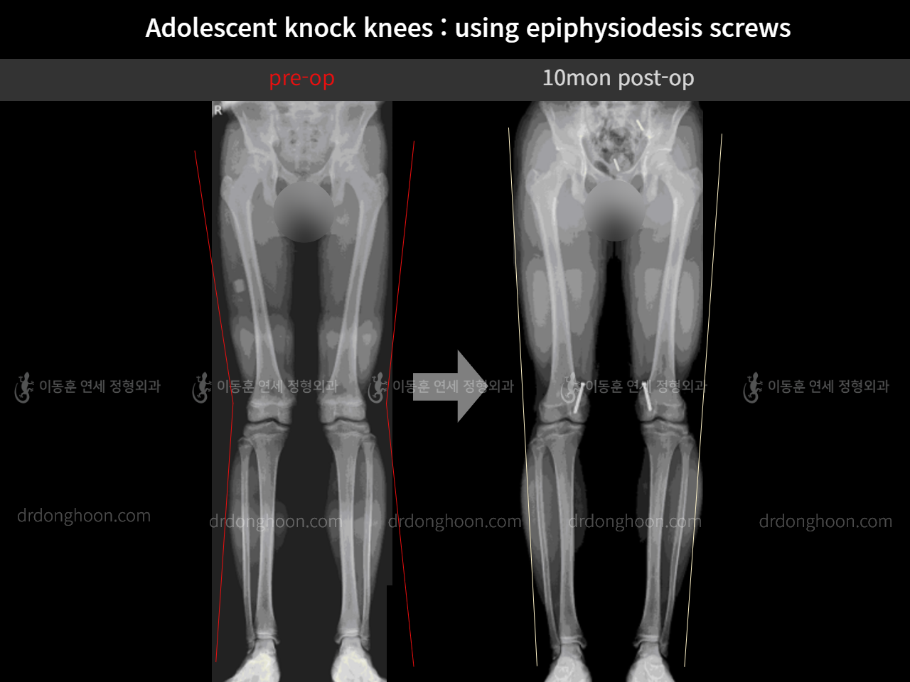 Before and after paediatric & adolescent knock knees, case 11511975, image 6, Dr. Donghoon institute (DALRI)