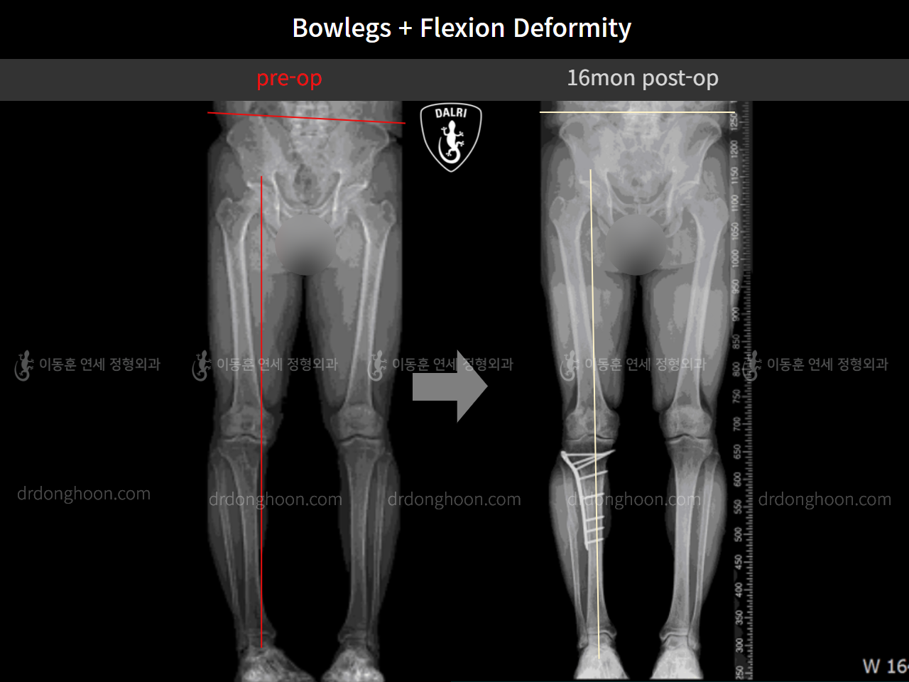 Before and after complex deformity, case 10451189, image 7, Dr. Donghoon institute (DALRI)