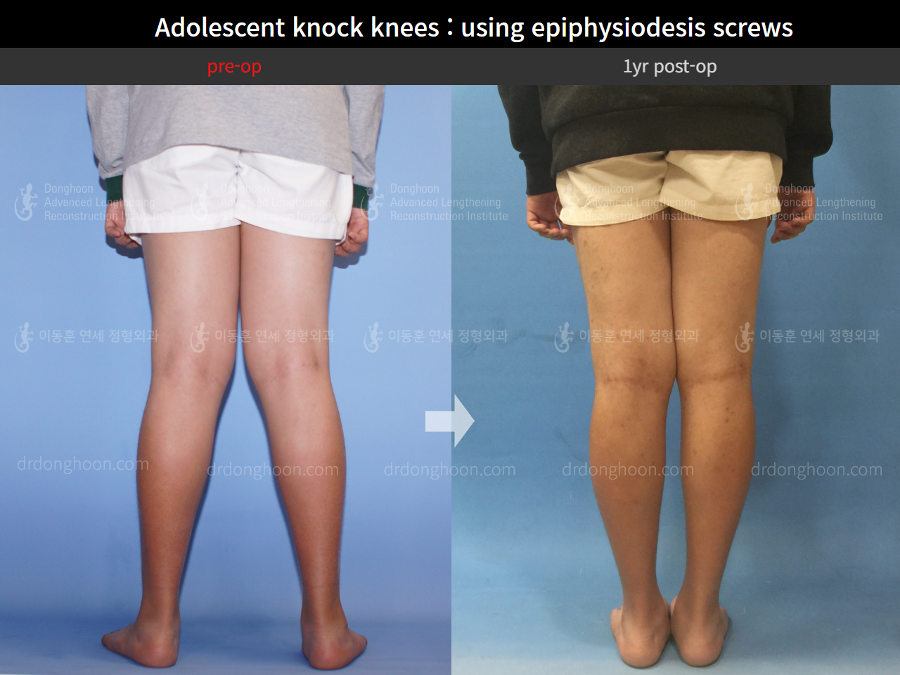 Before and after paediatric & adolescent knock knees, case 4310939, image 4, Dr. Donghoon institute (DALRI)