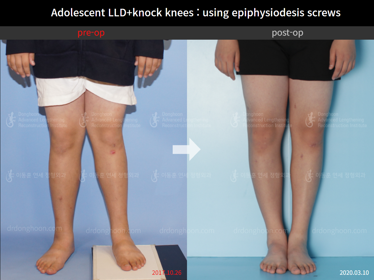 Before and after complex deformity, case 8835405, image 1, Dr. Donghoon institute (DALRI)