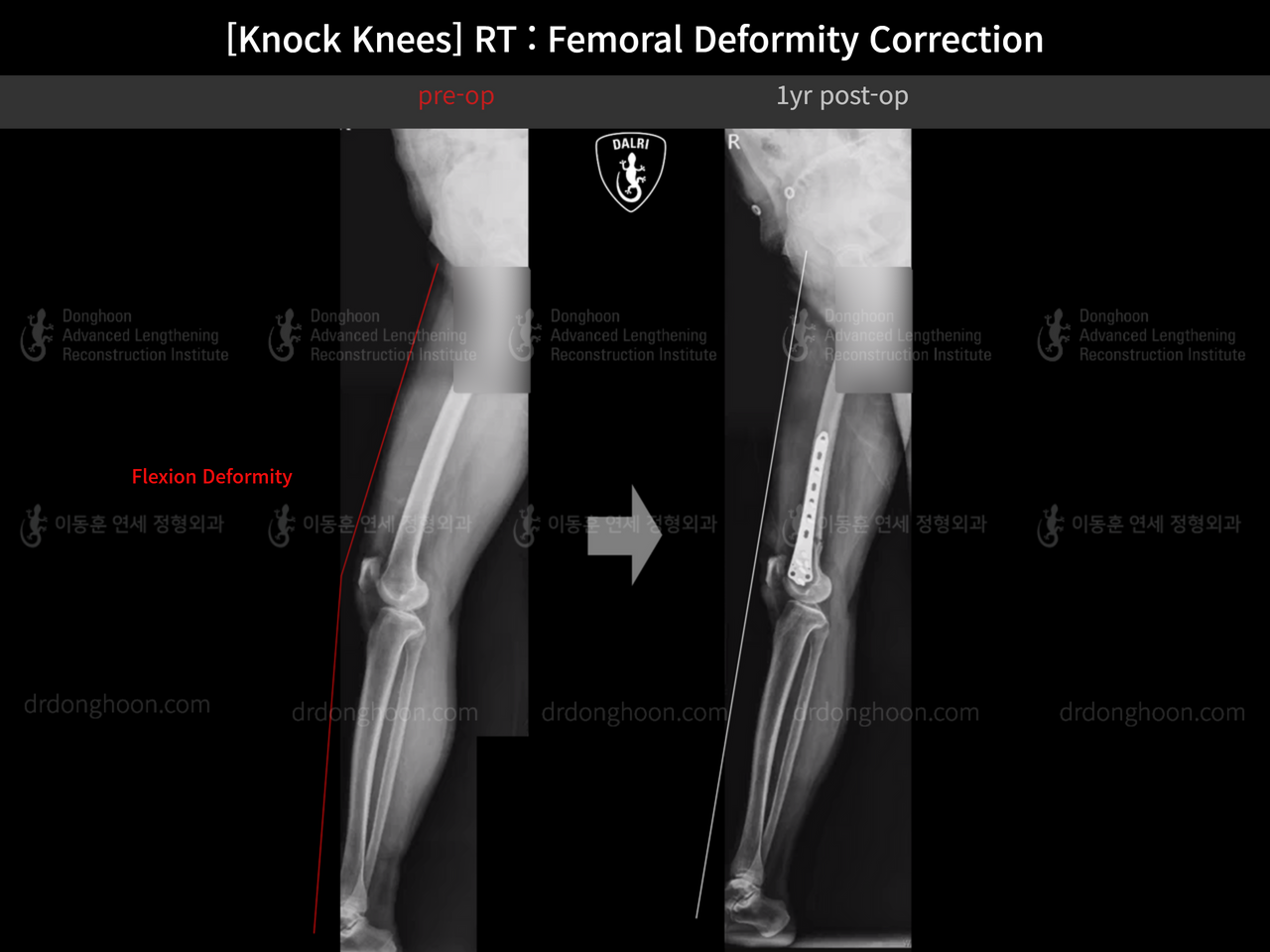 Before and after flexion deformity, case 14236440, image 13, Dr. Donghoon institute (DALRI)